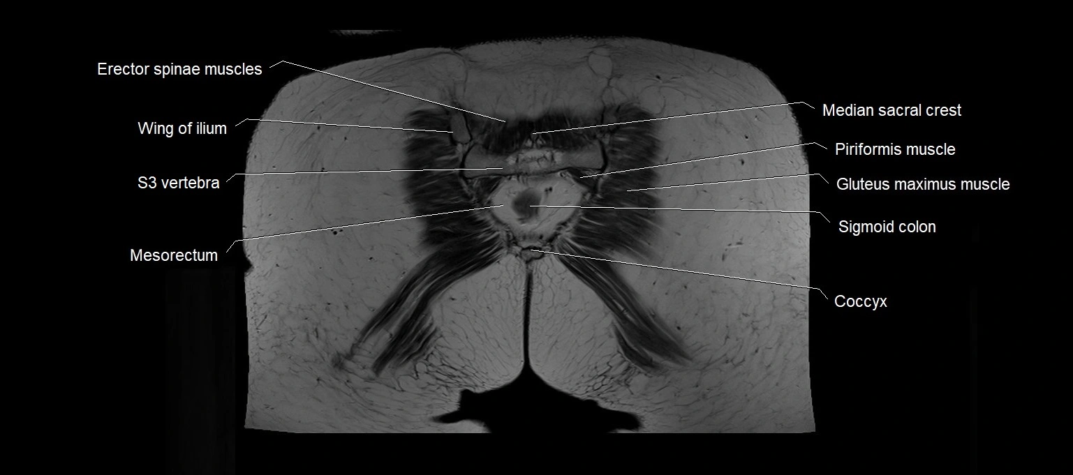 MRI 3T pelvis coronal cross section anatomy image 27.webp